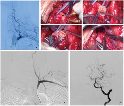 Microsurgical revascularization of a symptomatic proximal vertebral artery: pilot experiences from a single center